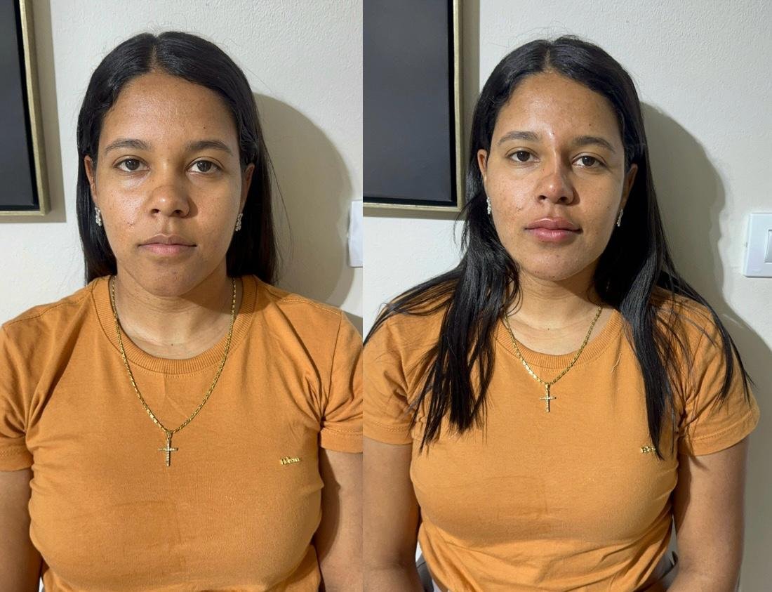 Harmonização Facial Feminina