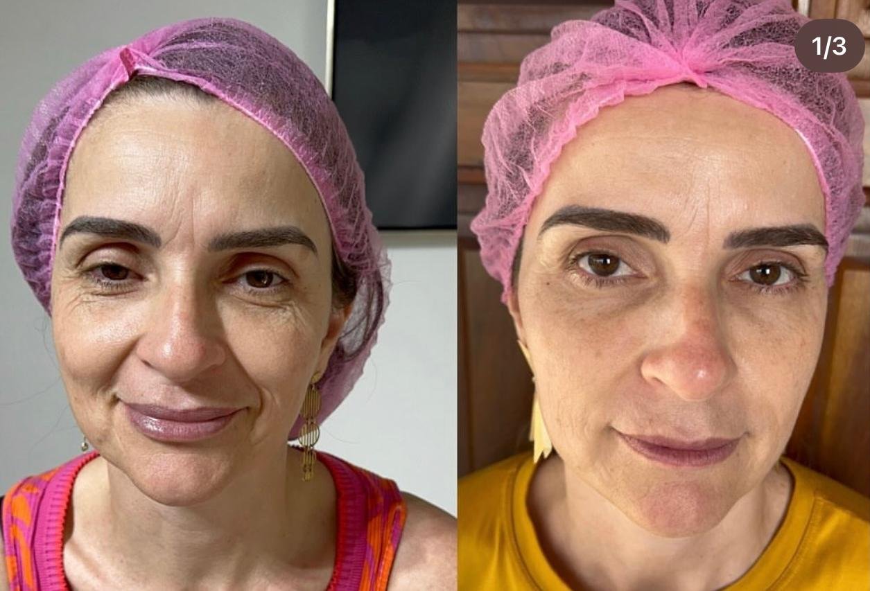 Rejuvenescimento Facial