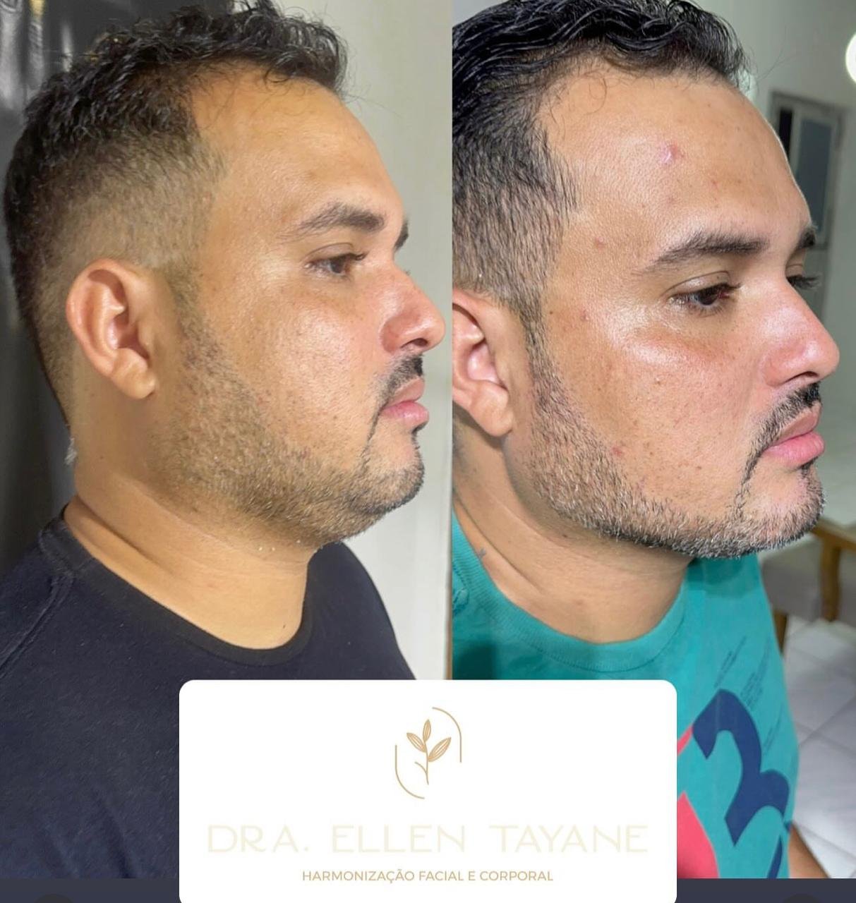 Harmonização Facial Masculina